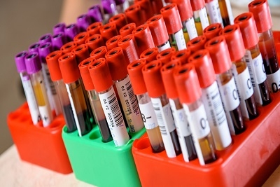 Biohemijska analiza krvi - popusti