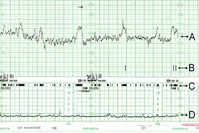 Kardiotokografija ili CTG u trudnoći.Popust