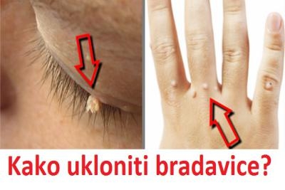 Uklanjanje visećih  bradavica na telu do 10 promena do 5 mm 